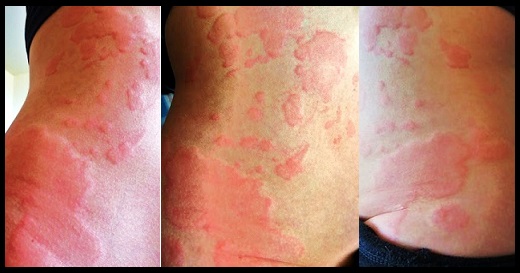 Hives After Drinking Alcohol Pictures Photos