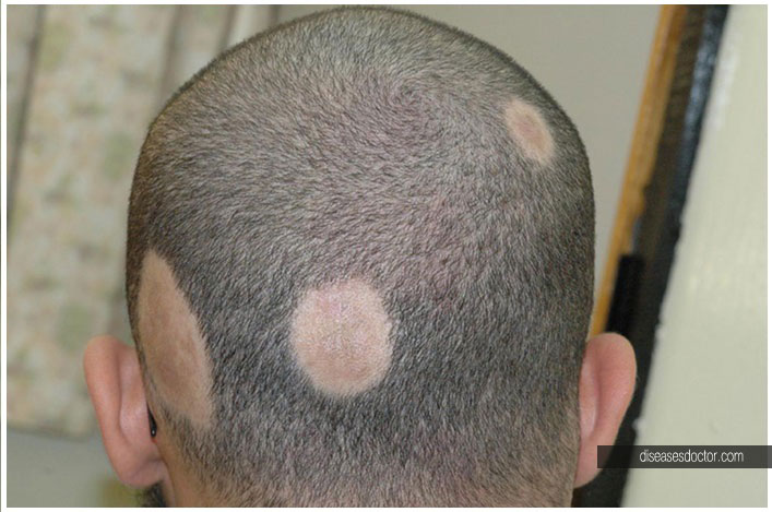 alopezia areata universalis